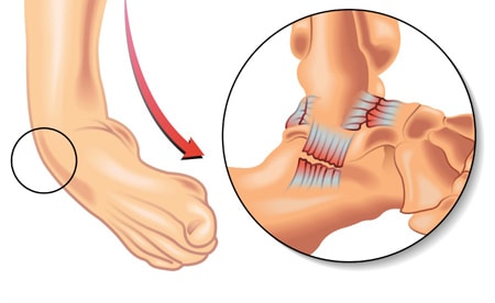 Bent ankle leading to sprain Sprain injury to the ankle ligament