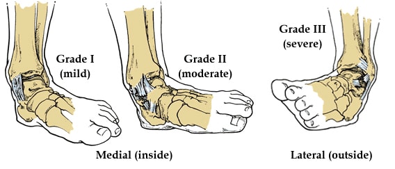 Sprain And Strain | Healthclues