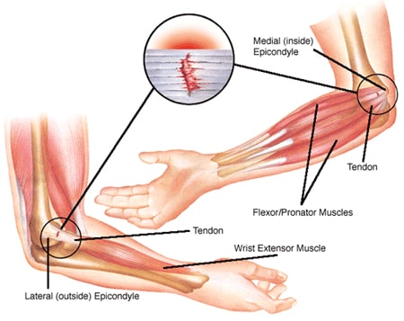 Elbow joint Causes of tennis elbow